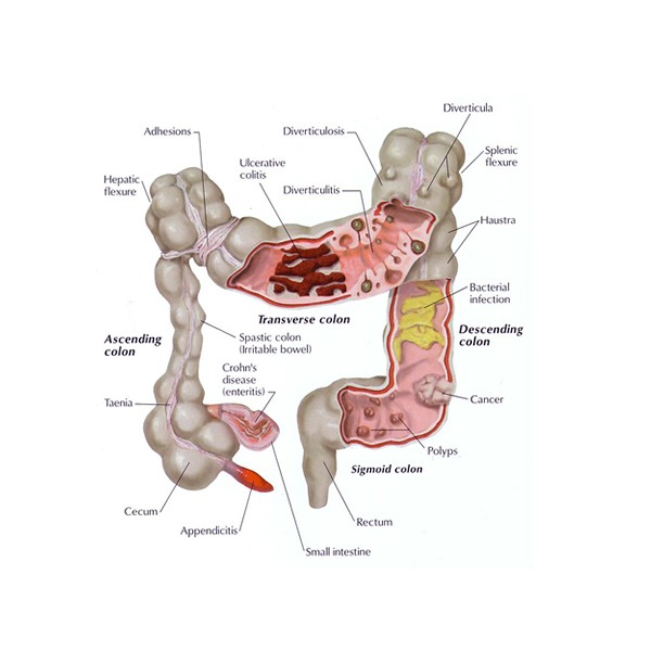 Sindromul de intestin iritabil – tratament | genunetwork.ro
